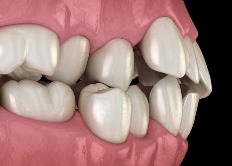 why you need Orthodontics