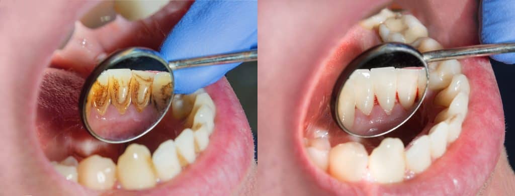 Removing plaque at a dental check-up