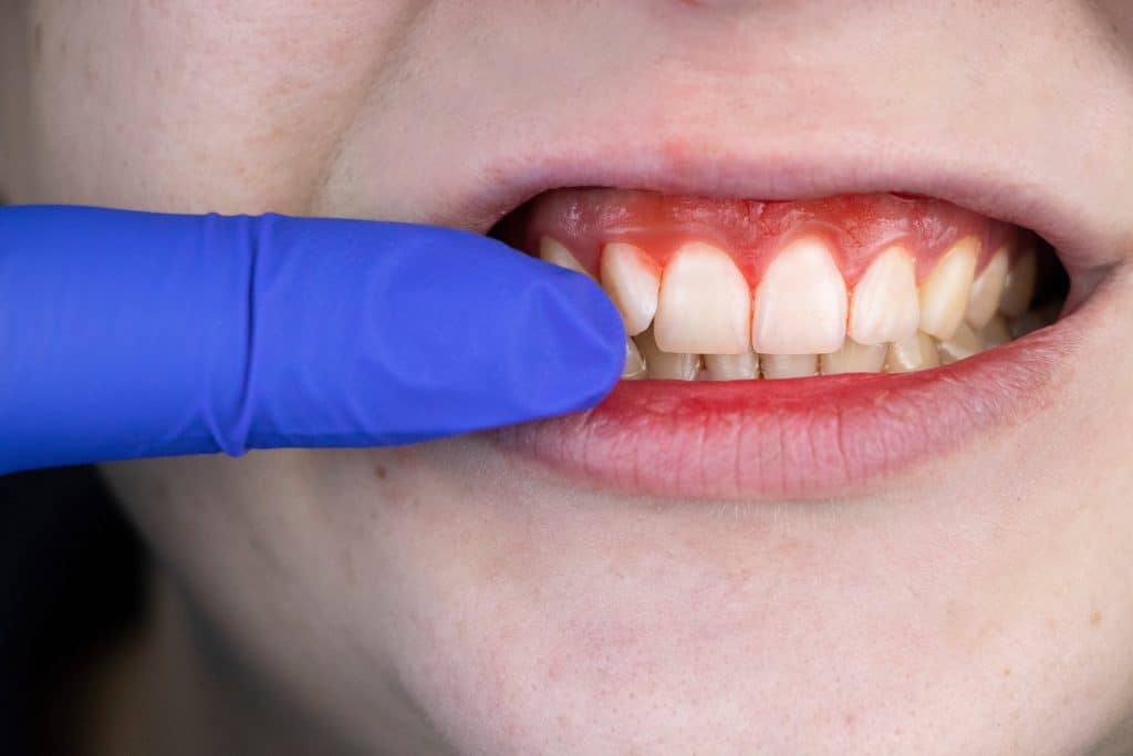 a patient showing signs of gum disease