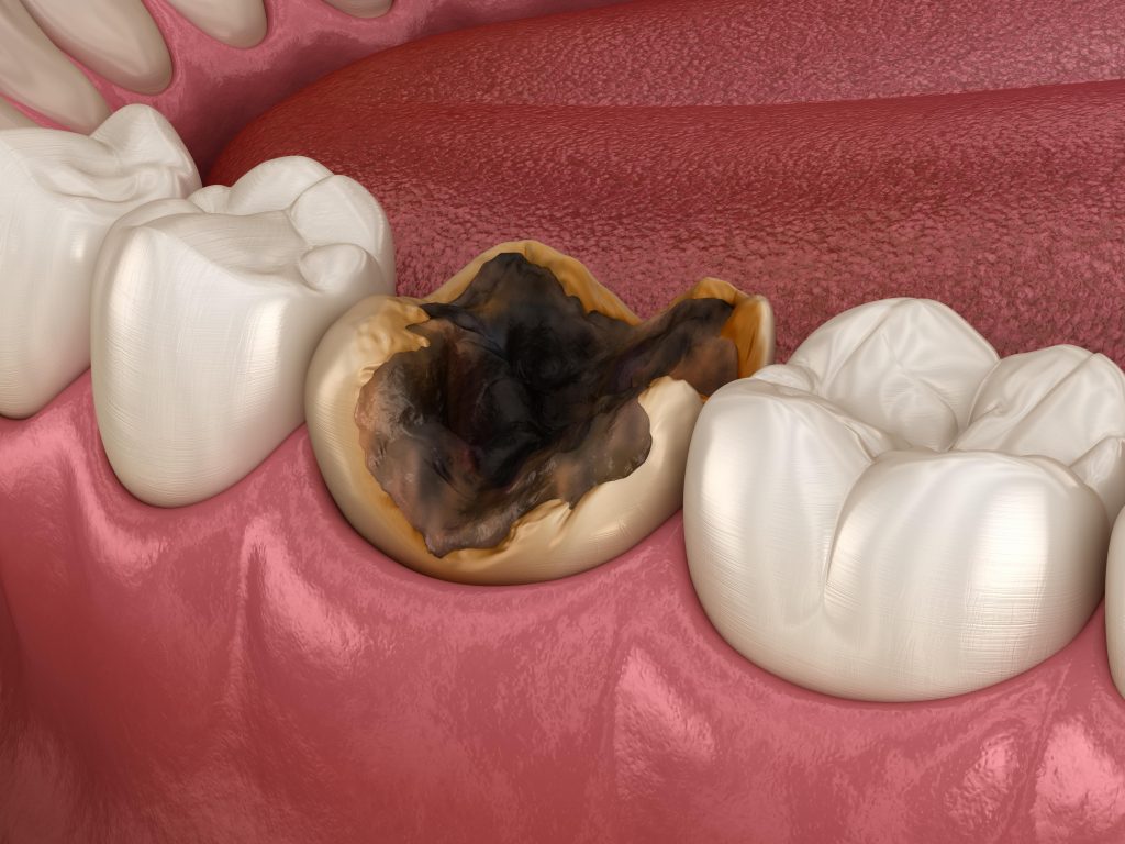 a dead tooth due to tooth decay