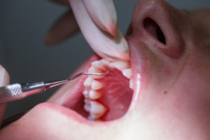 What is Teeth Scraping