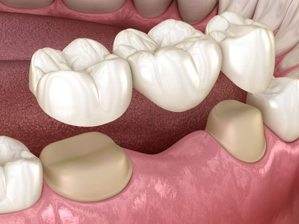 Dental Bridge vs Dental Implant