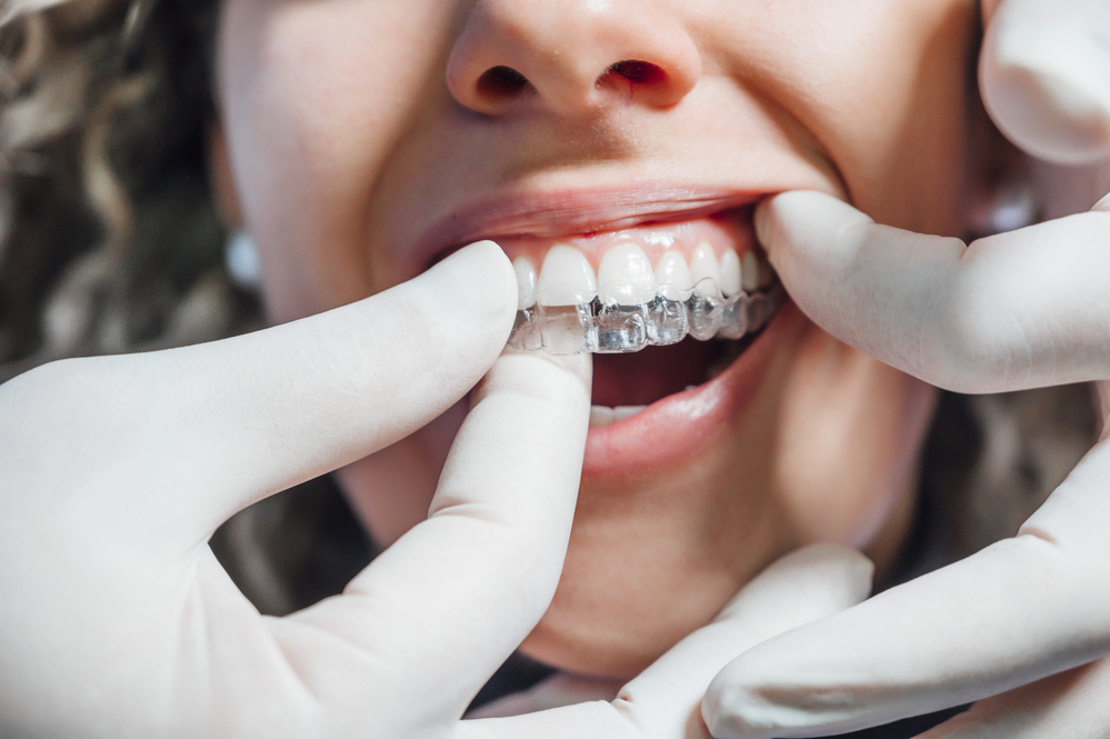 Cleaning Invisalign: Proven Tips for Optimal Oral Health