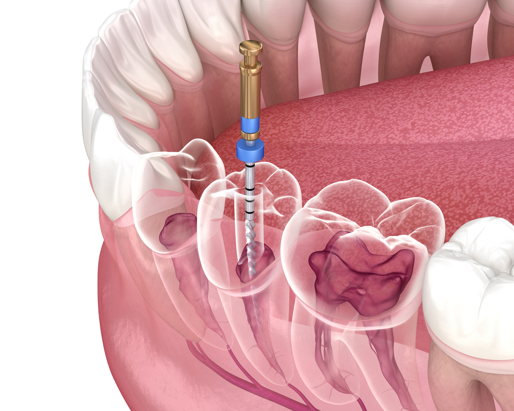 A Comprehensive Guide: How Long Will Your Root Canal Last?